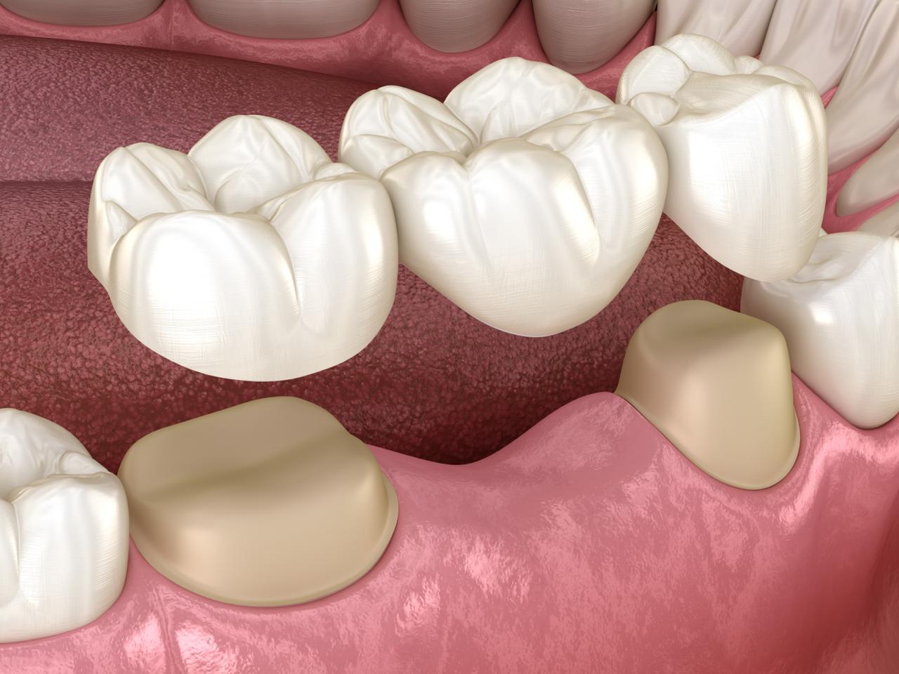Dental Bridges at Spixworth Dental Practice