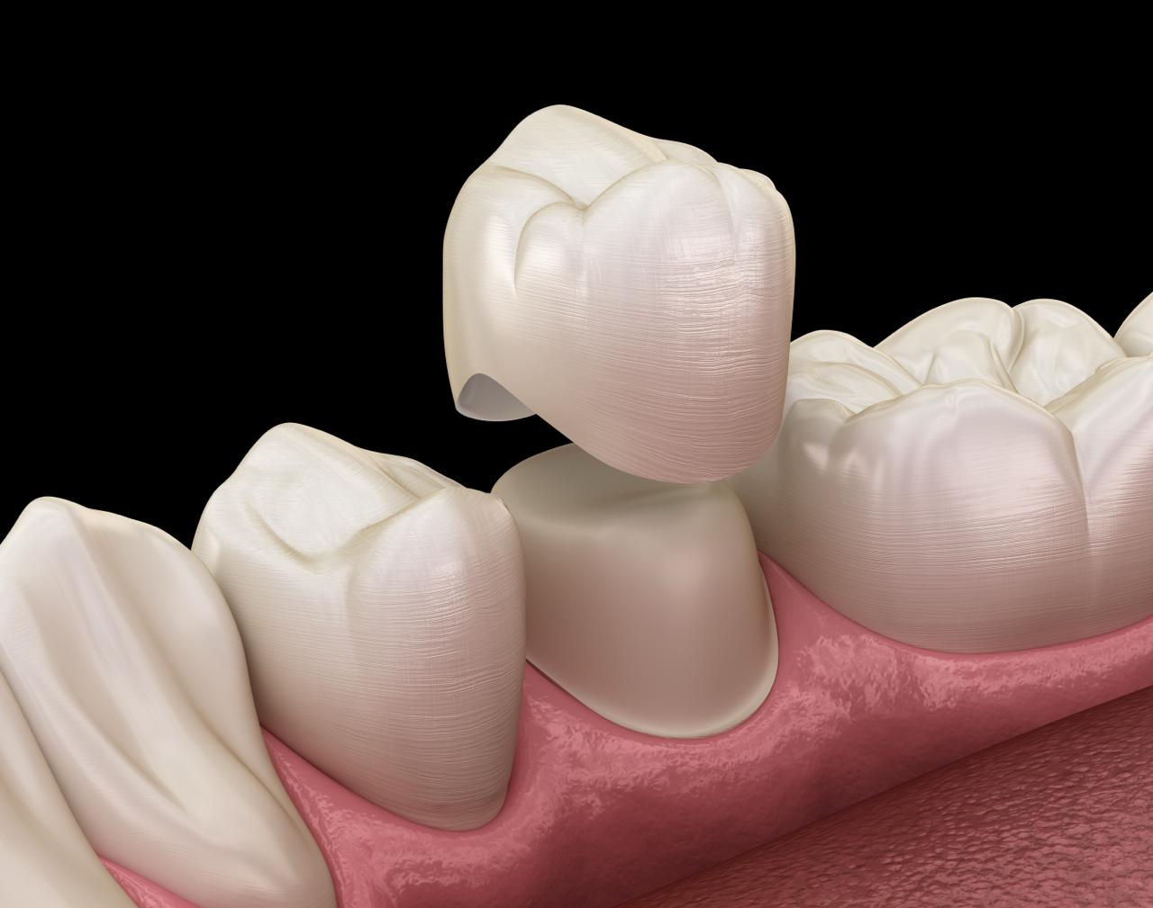 Dental crowns at Spixworth Dental Practice