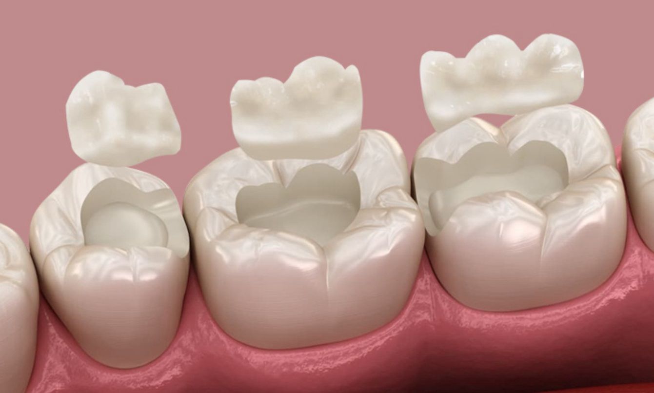 Dental bonding