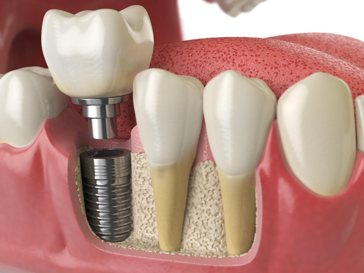 Dentures at Spixworth Dental Practice