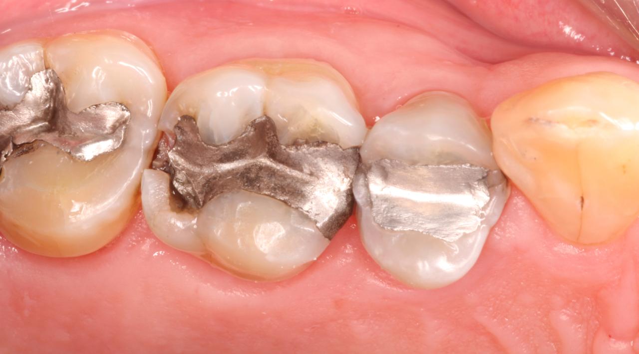 Dental fillings