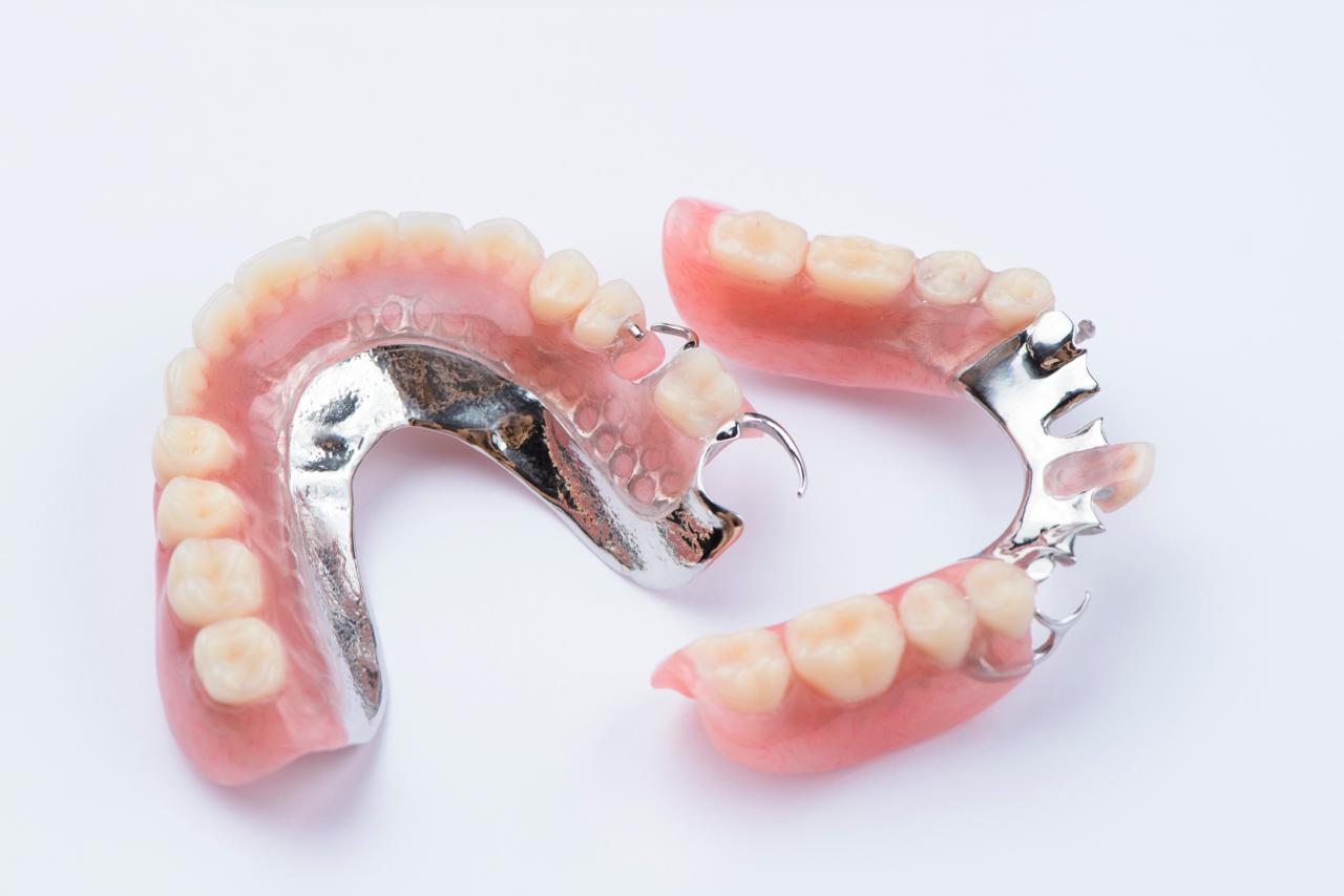 Dental implants at Spixworth Dental Practice