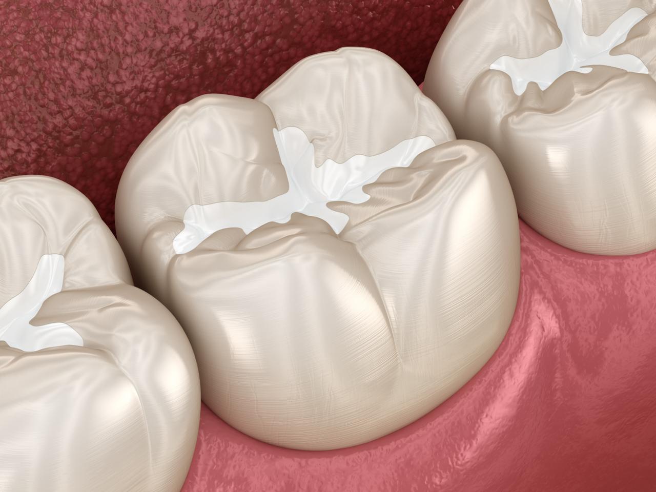 Onlays at Spixworth Dental Practice