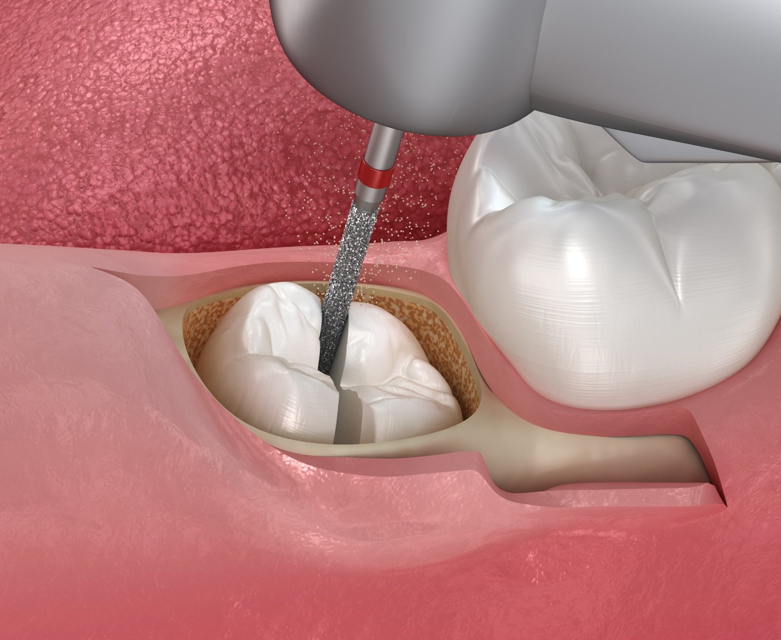 Surgical extractions